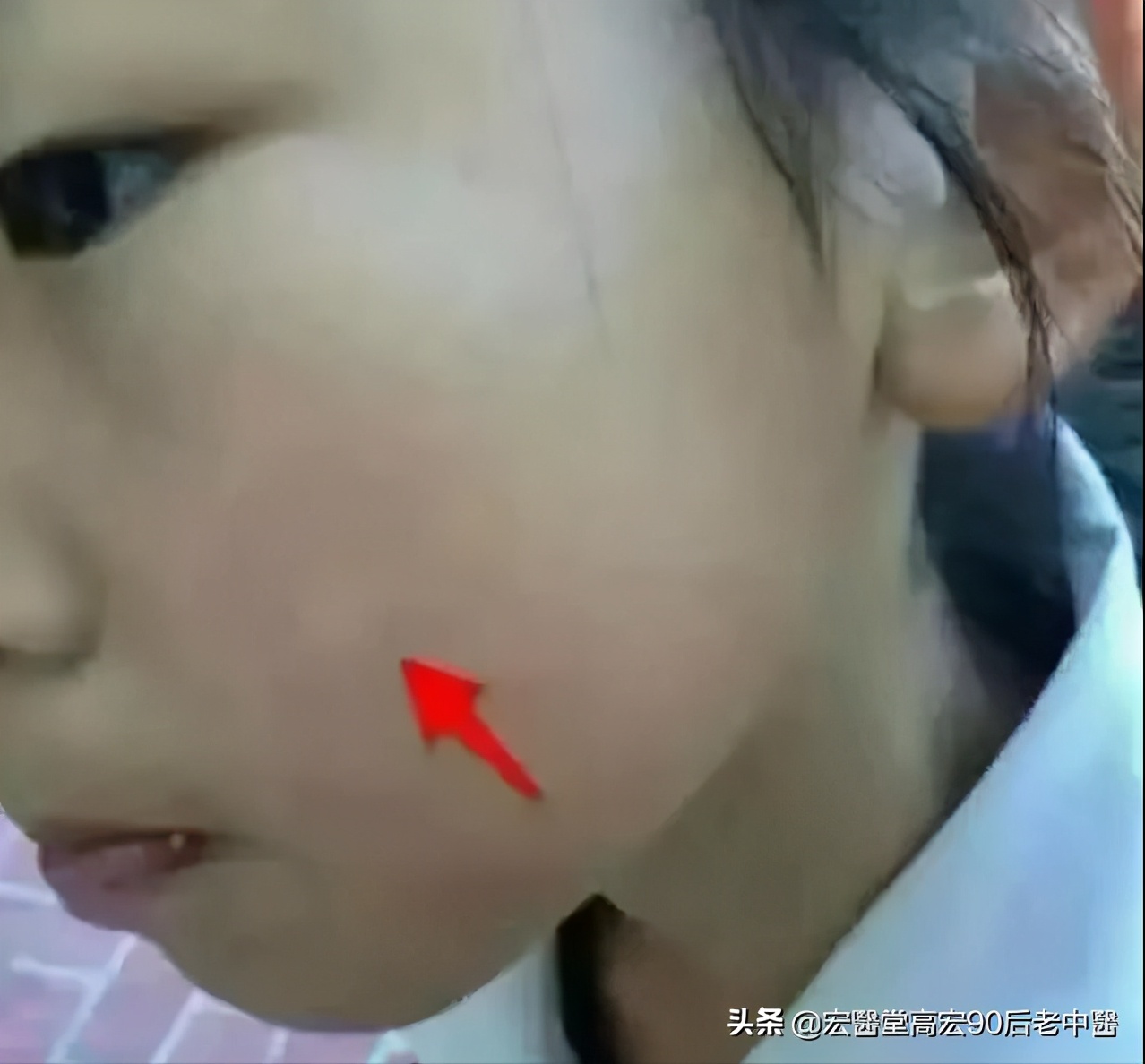 小孩胃有斑点是什么原因,小孩白斑早期症状有哪些