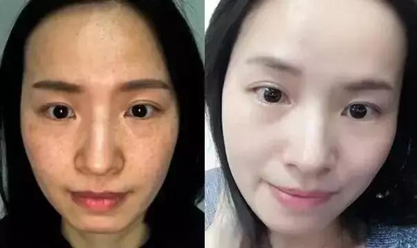 想要脱毛用什么最好,opt冰点脱毛仪器祛斑