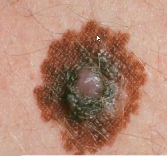 你身上的痣是什么,你身上的痣代表什么