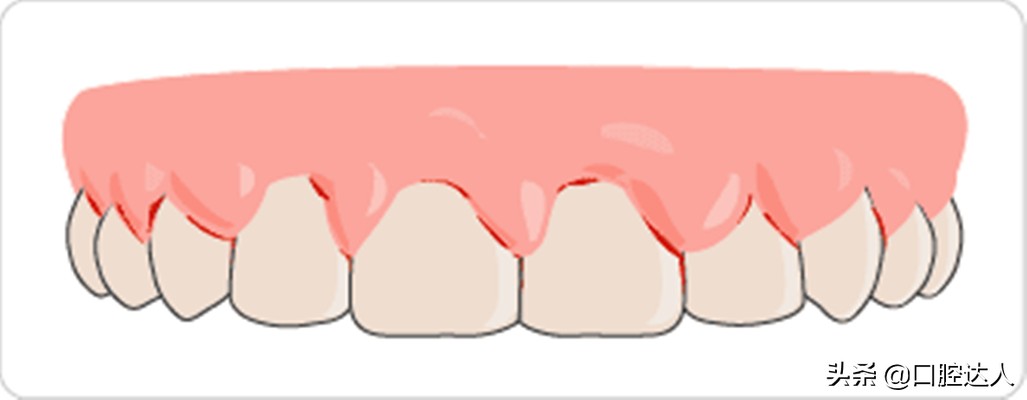有时候吸一下牙齿为什么会出血,有时候用力一吸牙出血