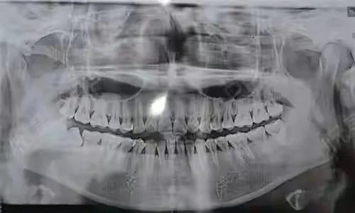 种植牙手术流程图解,口腔种植牙护士手术配台流程
