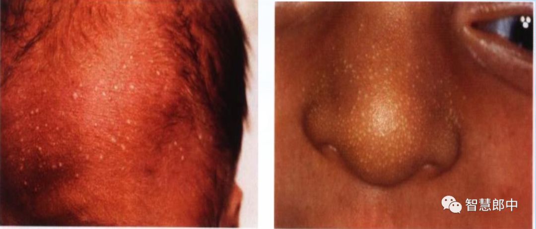 新生儿的几种生理现象图片,新生儿正常生理现象