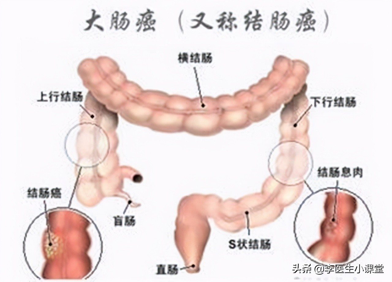 肠癌的6个早期症状治疗方法,肠癌来临前会先经历哪三个症状呢