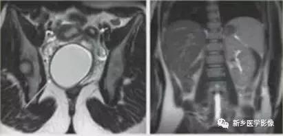 常见的几种子宫畸形诊断标准,先天性子宫畸形是什么原因造成的