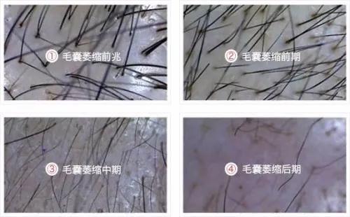 毛囊萎缩是个什么样的过程呢？为什么发量会日渐减少？
