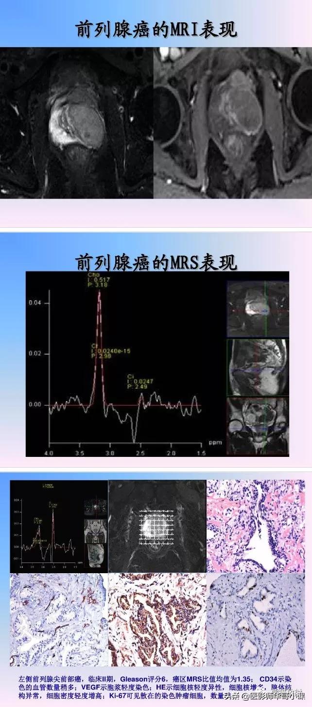 前列腺磁共振影像解剖,前列腺mri正常诊断报告模板