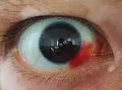 眼睛肿了会是感染新型肺炎了吗,新冠肺炎引起的眼睛红怎么治疗