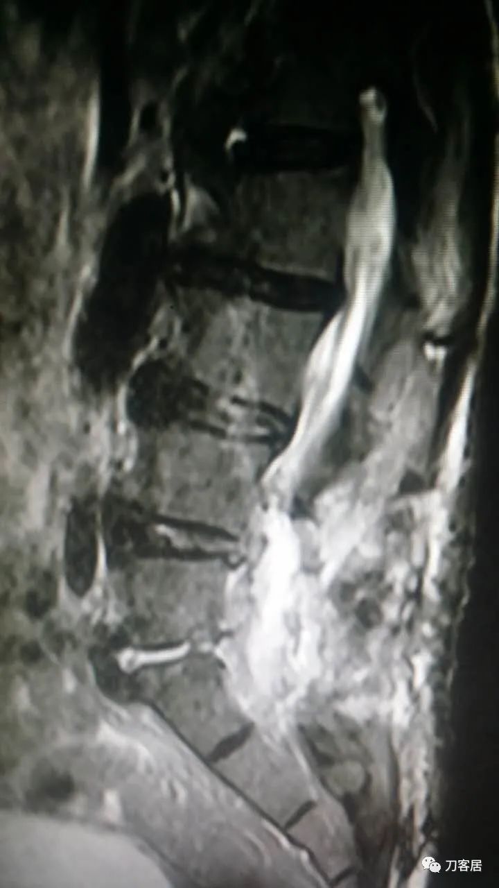 腰椎手术切掉棘突,腰突微创后出血肿