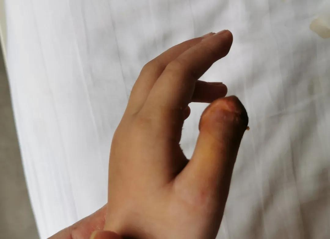 小女孩手被旋转门夹断,五岁小女孩手被门夹住