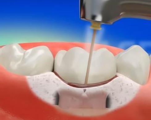 牙齿有黑三角会不会越来越严重,牙齿开始出现黑三角怎么办