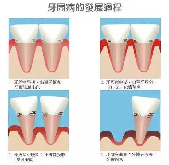 Helen齿科中心——你了解牙龈炎吗？