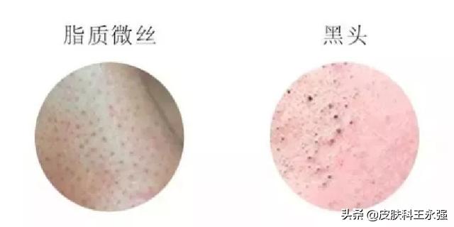 鼻子上挤出来黄色丝状物怎么解决,鼻子上挤出的白色状物到底是啥