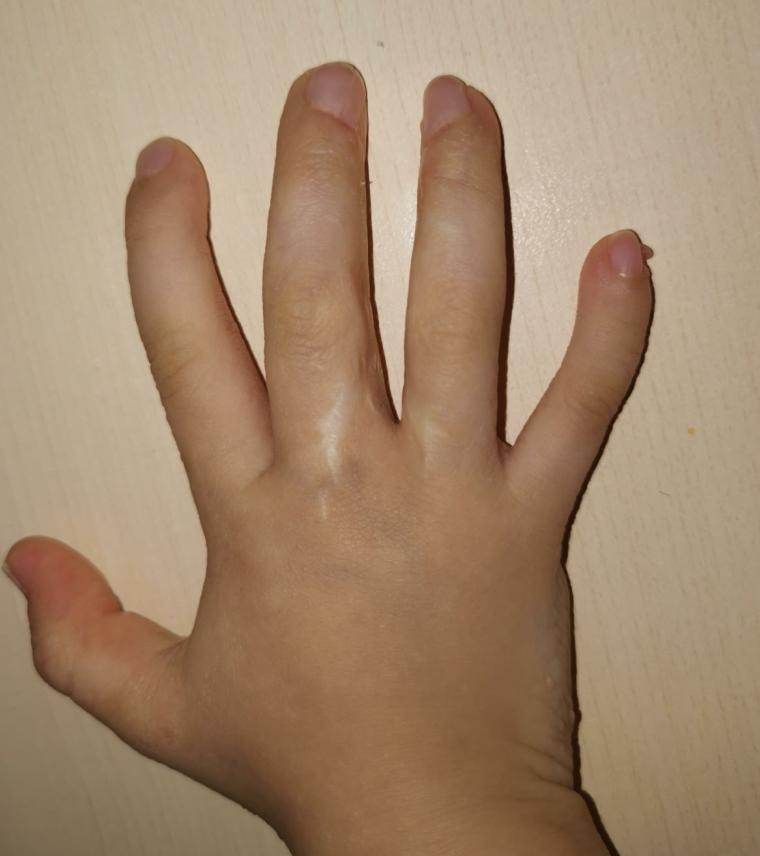 并指畸形免植皮案例,并指畸形