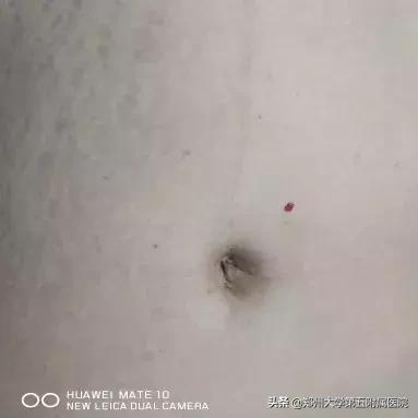 妇产科完成一例经脐单孔腹腔镜下巨大盆腔包块切除术