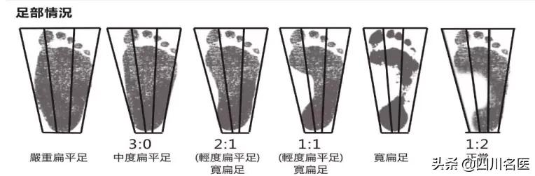 扁平足是不是走路容易脚疼,脚一走路就疼是扁平足吗