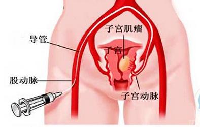 子宫肌瘤的十问十答科普,子宫肌瘤的10个常识