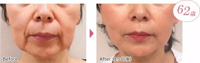 美白祛黄提亮肤色泡水喝,每天喝一杯可以美白淡斑清热解毒