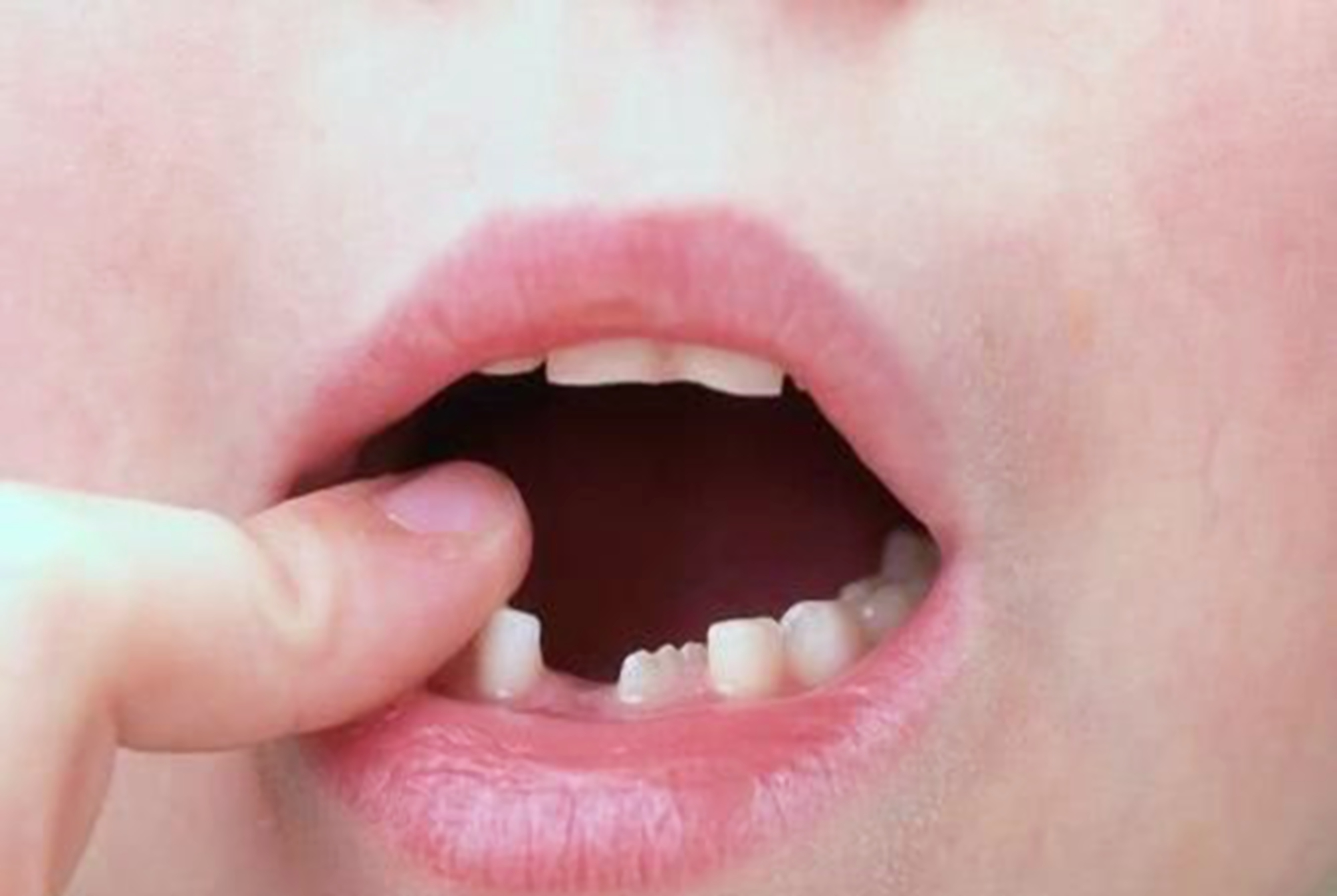 宝宝掉牙了应该怎么处理,宝宝掉牙了怎么办小视频