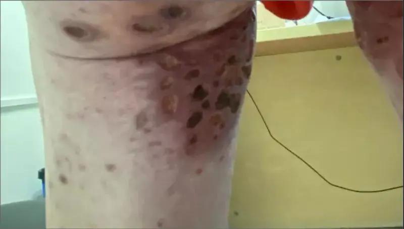 得湿疹了自己会好吗,得了湿疹要忌什么