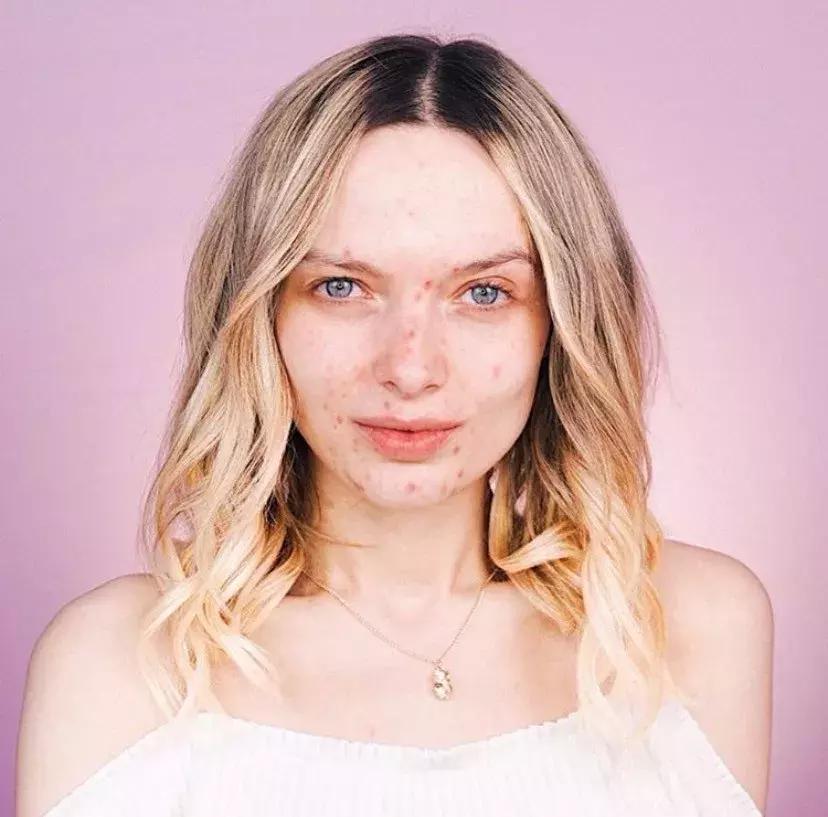 黑眼圈色斑严重怎么办,去除色素型黑眼圈的最快方法