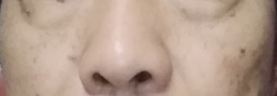 油溅到脸上有黑斑多久消失图片,脸上被太阳晒的黑斑怎么去除