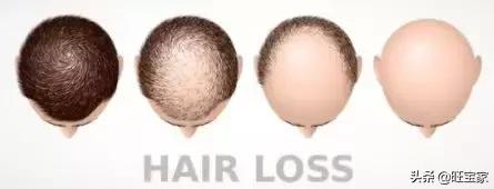 生娃是罐秃顶剂,从此我变成了裘千尺