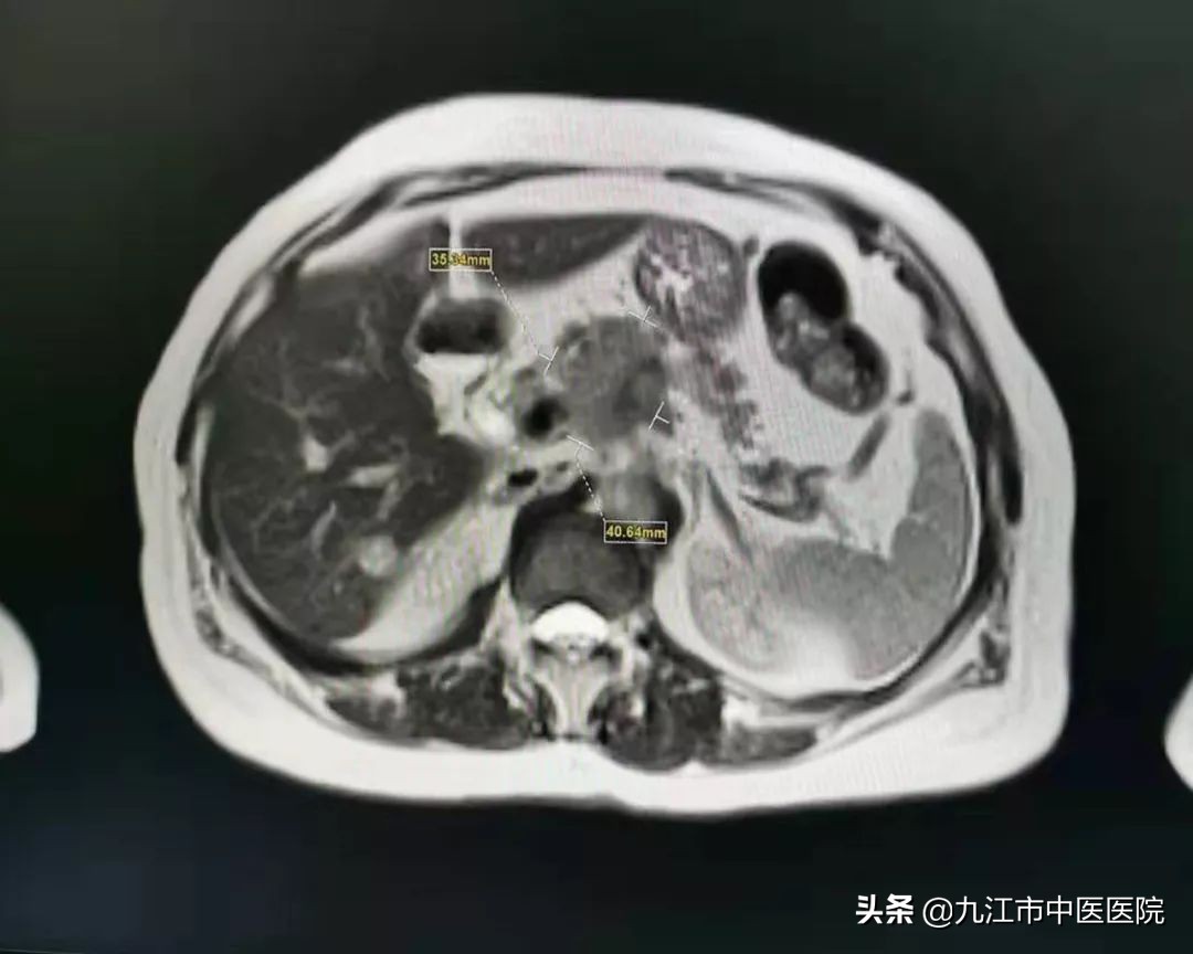 胰腺癌晚期中药治疗带瘤生存奇迹,胰腺癌中医治疗生存期