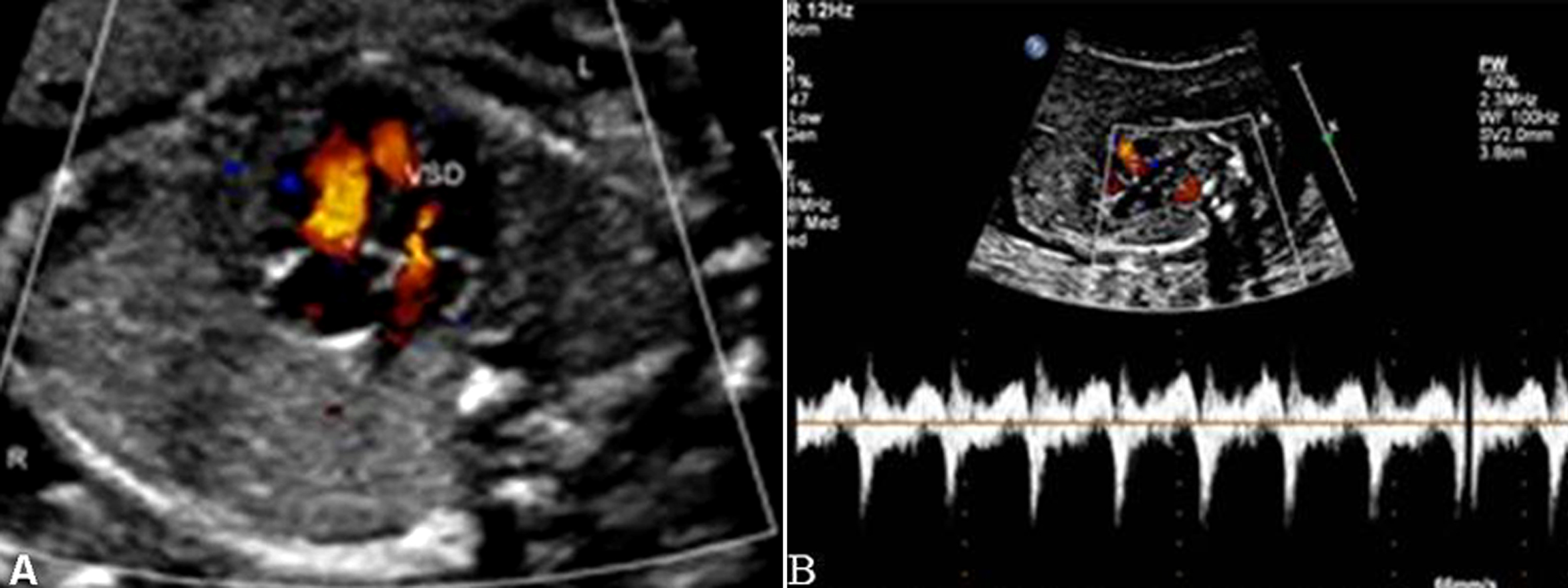 胎儿心脏发育异常微小室间隔缺损,胎儿心脏缺损1.3毫米严重吗