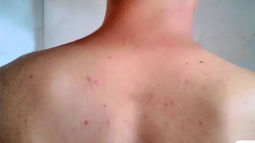 前胸后背长痘痘是毛囊炎吗,前胸后背很容易长痘痘中医治疗