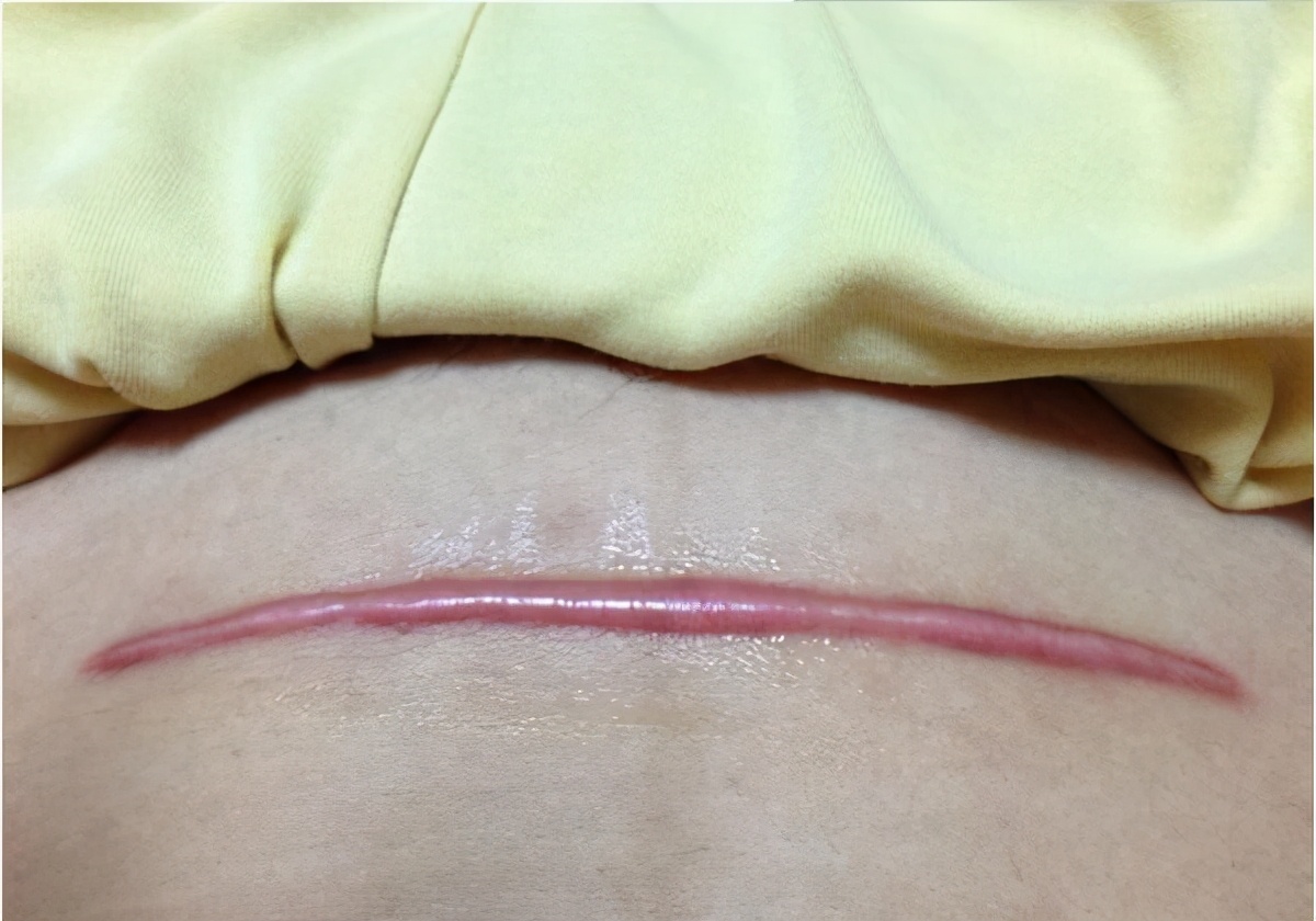 增生疤痕治疗多少钱,激光治疗增生性疤痕