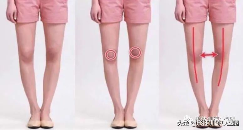 o型腿和罗圈腿图片对比,o型腿和罗圈腿的区别