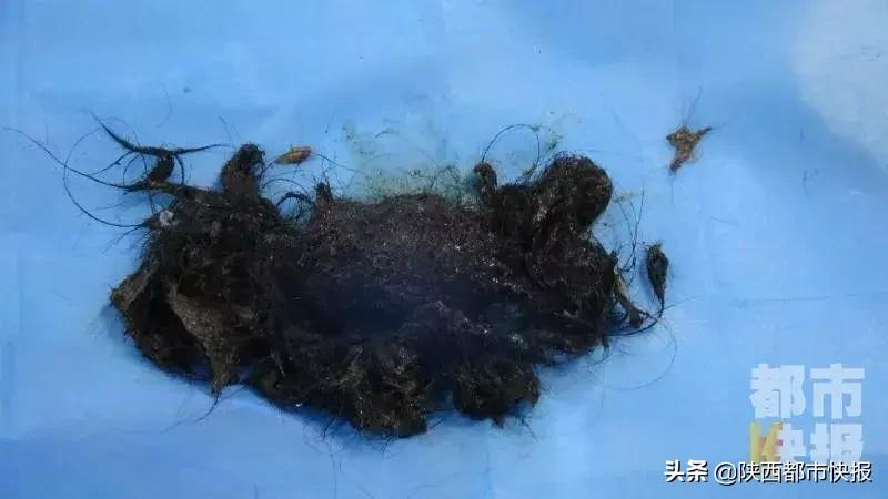西安一女孩吃头发,86岁女童胃里取出2斤头发