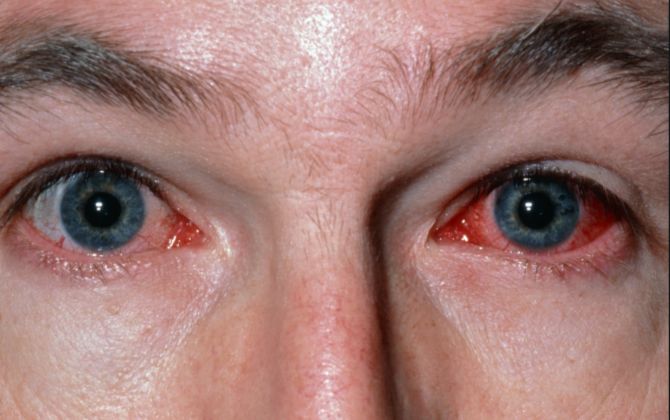 约炮软件流行加拿大某省性病大爆发