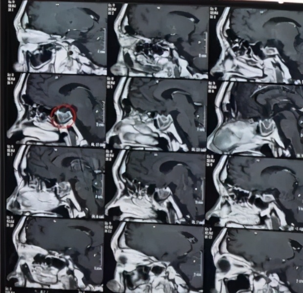 药物过敏导致心脏骤停,麻醉过敏心跳停止如何抢救