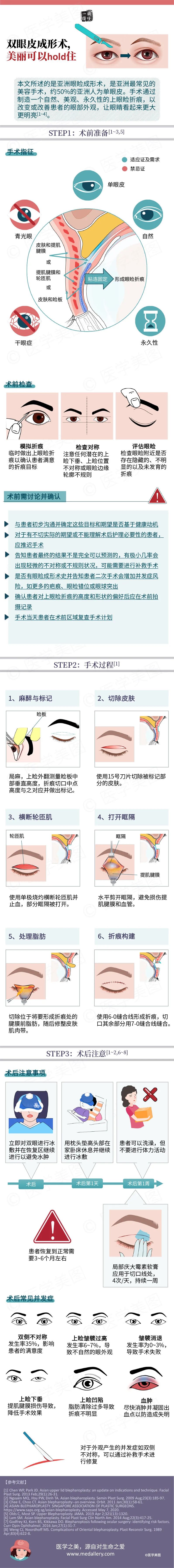 对割双眼皮的看法,你对近视的误解