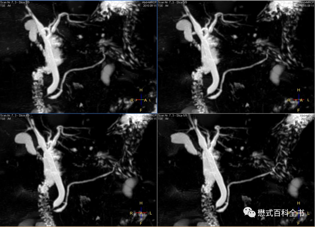 开展mrcp技术,mrcp检查操作流程