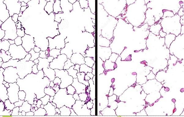 戒烟后如何将肺部清洗干净,戒烟后怎么清理肺部烟毒