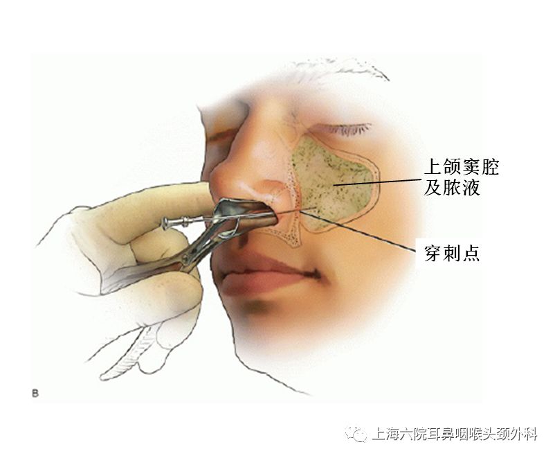 上颌窦炎穿刺手术全过程,上颌窦炎一般小门诊能治疗吗