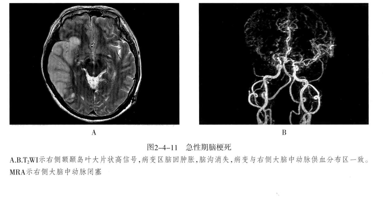 颅内血管周围间隙的影像鉴别,颅脑血管源性疾病影像诊断