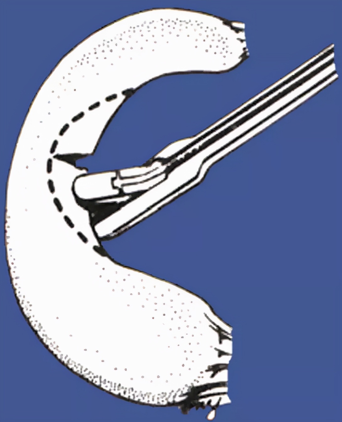 关节镜的适应症是什么,关节镜操作流程及注意事项