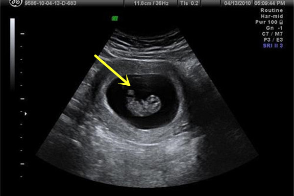 孕晚期除了破水见红还有什么征兆,临近预产期见红了但是肚子不疼