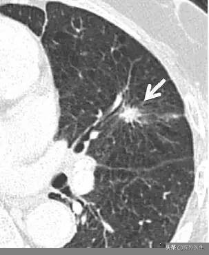 肺结节属于什么肺病,肺结节是什么病需要做化疗吗