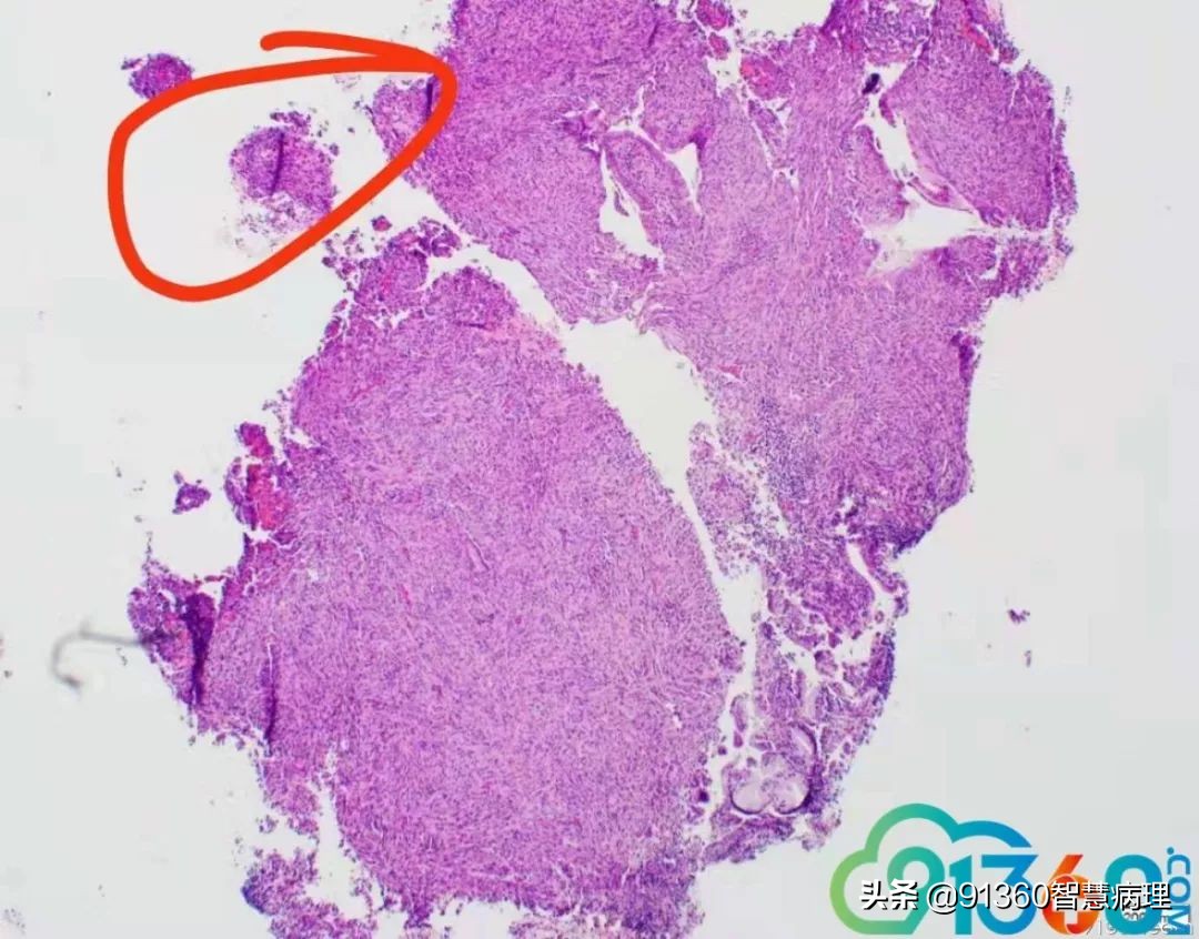 宫颈腺癌silvaa型严重吗,宫颈腺癌silvab型复发率高吗