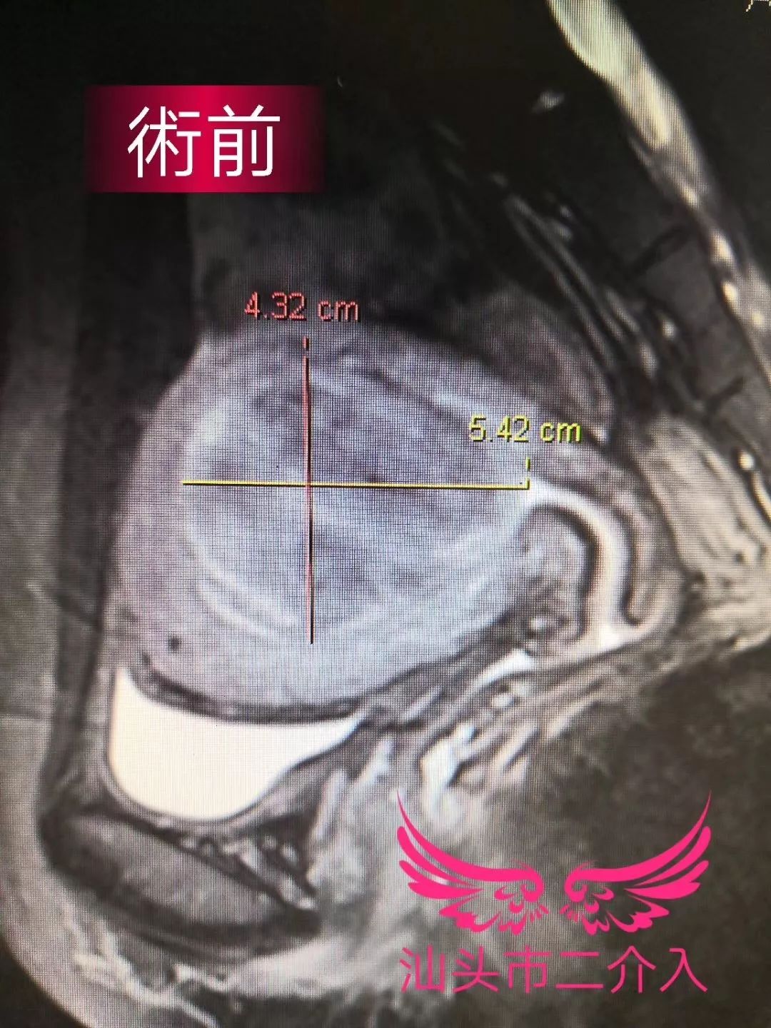 子宫肌瘤无创消融手术,无疤痕子宫肌瘤手术