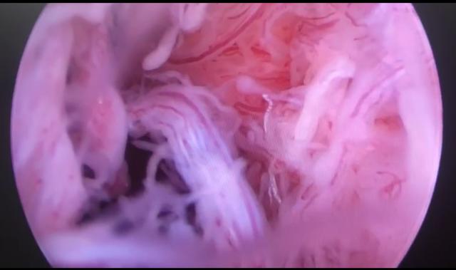 中医治疗类风湿性关节炎中成药,类风湿关节炎中医西医结合方案