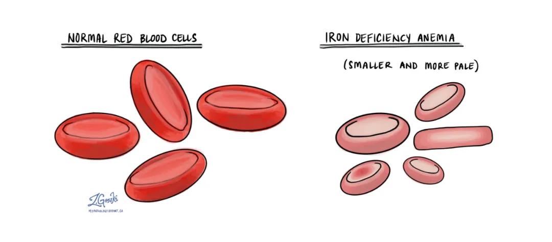 六个月宝宝缺铁又不吃辅食怎么办,十个月宝宝缺铁可以吃什么辅食