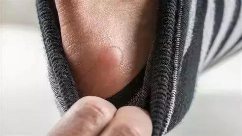 跑步跑出黑指甲怎么处理,跑步脚上出现黑趾甲该怎么处理