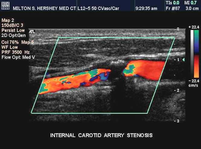 成年人脑梗继发癫痫最佳治疗方法,脑梗死癫痫部分发作