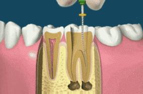 牙齿戴冠还会劈裂,戴冠后牙会不会劈裂