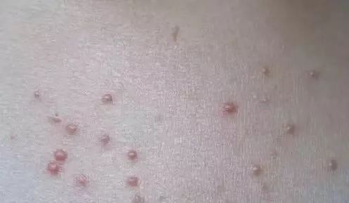 长了汗管瘤容易长皱纹,为什么会长汗管瘤和脂肪粒